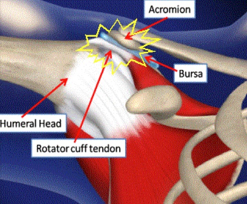 Picture: Shoulder impingement